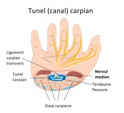 Sindrom de tunel carpian